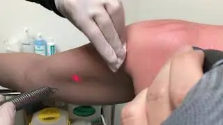 Vergetures trait&eacute;es par Laser.  