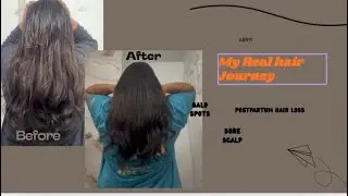 My REAL HAIR journey | Postpartum Hair Loss, Bald Spots & Frizz