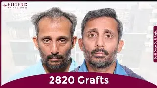 Incredible Hair Transplant Journey at Eugenix Hair Sciences | Before & After Results