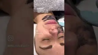 Carbon Laser Facial - A red carpet facial that targets large pores and exfoliates dead skin cells.