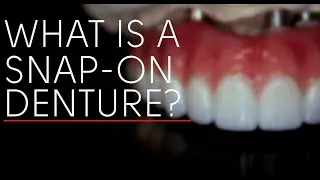 Understanding Snap-On Dentures: Your Guide to a Confident Smile