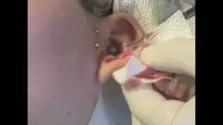 Angelina's scalpelled ear