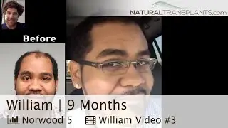 Hair Transplant Before and After Men | 9 Months After Hair Transplant (William)