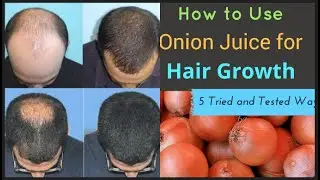 Onion Juice For Hair Growth Results, DIY Onion Juice Hair Regrowth Success, Onion Juice For Baldness