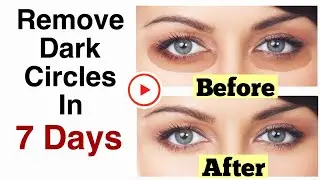Foods That Help In Reducing Dark Circles Naturally | How To Get Rid Of Dark Circles Home Remedies