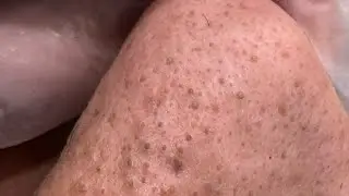 Say Goodbye to Blackheads + Large Pores (my daily routine)