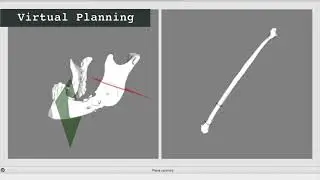 Robot Assisted Osteotomies in Mandibular Reconstruction using Fre Fibula Flaps (LIRMM) *