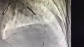 Radial artery perforation during stenting and management