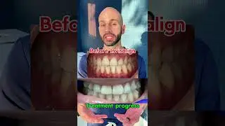 Can Invisalign Fix Underbite?
