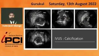 DR.INDERJEET MONGA- IVUS GUIDED ROTA IN POST CABG
