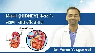 Kidney Cancer | Causes | Symptoms | Prevention | Treatment | Dr. Varun Agarwal(in Hindi)
