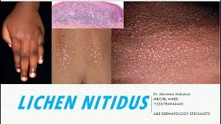 LICHEN NITIDUS BY DR ABRAHAM#educational #lecture #dermatology #science #dermatologist