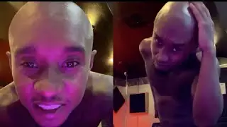 Slim Jxmmi Gets Defeated By Male Pattern Baldness