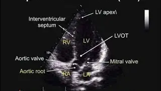 Apical 5CH view #echocardiography #echo #heartmonitoring #heartcare @SafaMedicalLecture