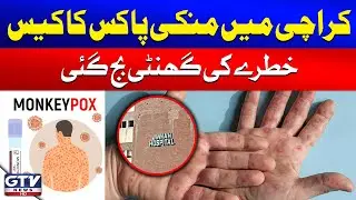 Monkeypox Case in Karachi | Latest Updates | Breaking News