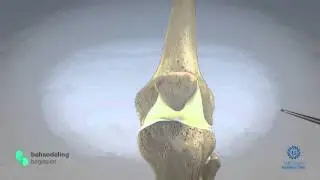 Uitleg behandeling microfractuur, Mobility Clinic