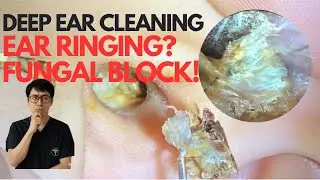 Why Are Your Ears Ringing? Silent Fungal Growth Filling the Ear Canal! - ASMR