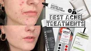 5 BEST ACNE SKINCARE TREATMENTS | Overnight Acne Treatments