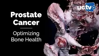 Prostate Cancer: Optimizing Bone Health