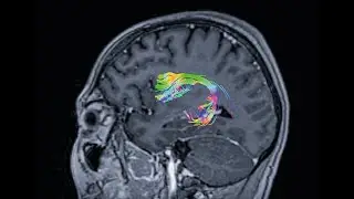 Broca's Area: The Producer Of Speech