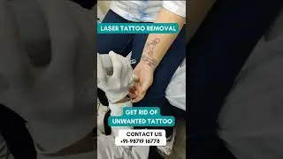 Painless Laser Tattoo Removal in Delhi - #lasertattooremoval #lasertattoo #laserclinic