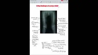 SCURVY//X-RAY//VITAMIN C DEFICIENCY//PAEDIATRICS//RADIOLOGY