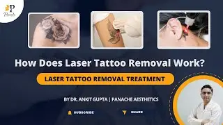 Laser Tattoo Removal | How to Get Rid of Tattoo | Tattoo Removal Explained | Q Switch vs PICO