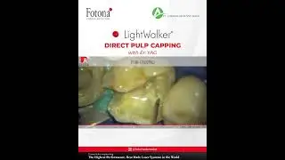 Direct Pulp Capping Treatment - Fotona Dental Laser LightWalker
