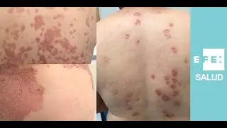 Tratamientos biológicos: 