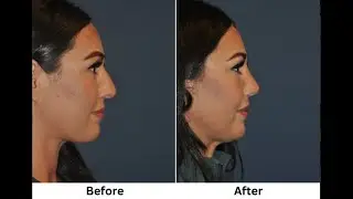 Rhinoplasty patient, 31-year-old, who is 3 months post op. Nose job performed by Dr. Freeman.