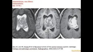 93. Central neurocytoma and septum pellucidum; intraventricular tumor, septum and frontal horns