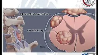 Spinal Tumours (1)  أورام العمود الفقري و الحبل الشوكي