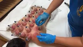 Cupping Massage - helps to improve blood circulation, alleviate muscle tension