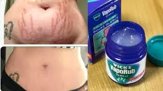 Vicks Vaporub For Stretch Marks