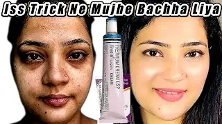 My Tretinoin Routine Revealed: What I Did to Beat Dryness and Peeling! | Indian Youtuber Anmol
