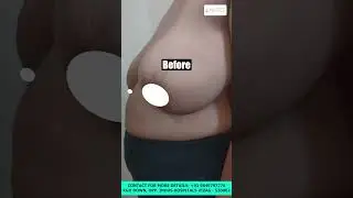 Heavy Breast Solution | Breast Reduction Surgery in Vizag | VJS Clinics
