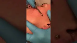 Dermaplaning Treatment before Chemical Peel