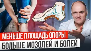 Как распознать и вылечить полую стопу быстро