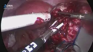 Laparoscopic Surgical Staging To Determine Resectability of Ovarian Tumours (LSS-DR)
