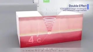 Doublo   S HIFU
