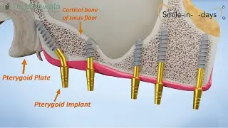 Pterygoid Implant placement &copy; 3D Animation video