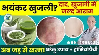 Khujli Kaise Thik Kare? 🌿 दाद खाज खुजली का घरेलू उपाय | Ringworm Treatment at Home