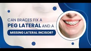 Can braces fix a peg lateral and a missing lateral incisor?