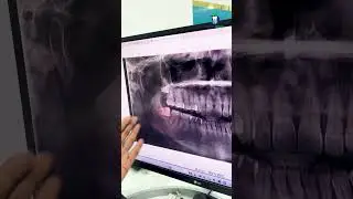 வலிக்காத ஞானப் பல்லையும் எடுத்து விடுங்கள்! - Preventive Extraction of Wisdom Tooth! | Denta Kings