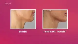 Profound Treatment  | Spectra Medical India