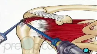 Rotator Cuff Repair - Arthroscopic Surgery PreOp® Patient Education