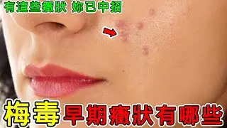 【健康】梅毒的早期症状有哪些？我們應該如何預防？#健康 #養生
