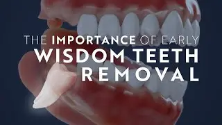 The Importance of Early Wisdom Teeth Removal