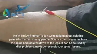 Dryneedling Treatment for Sciatica pain 
