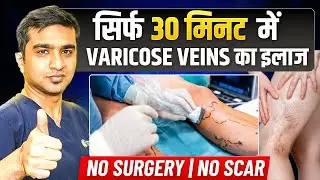 Varicose Veins Treatment Without Surgery | 30 Minutes Procedure | Dr Ashank Bansal